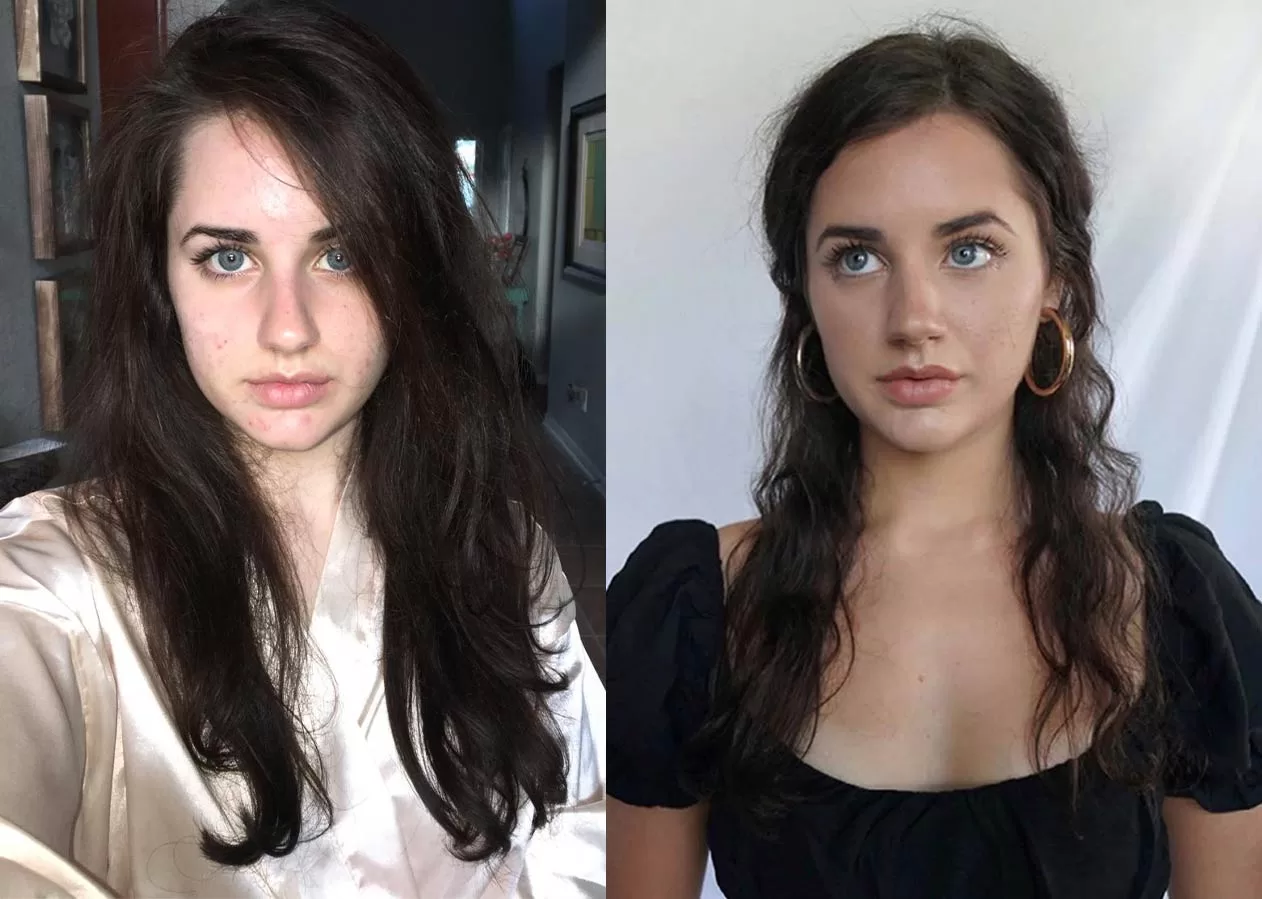Hair-Loss-Comparison Alexan Ashcraft before and after hair loss